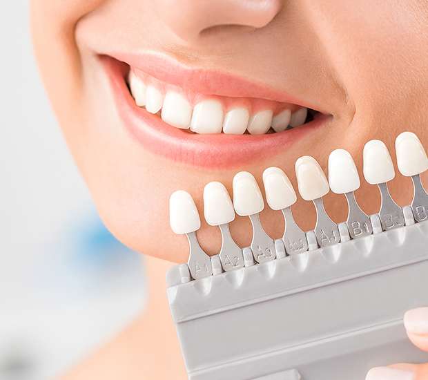 Sonoma Dental Veneers and Dental Laminates
