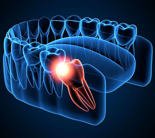 Sonoma Wisdom Teeth Extraction